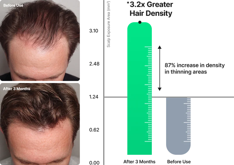Clinical Scalp Activation, 
Maximum Power 
Against Hair Thinning